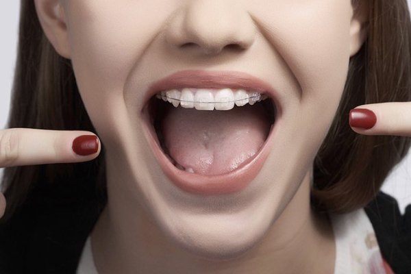 آیا دندانها بعد از ارتدنسی کاملاً قرینه میشوند؟