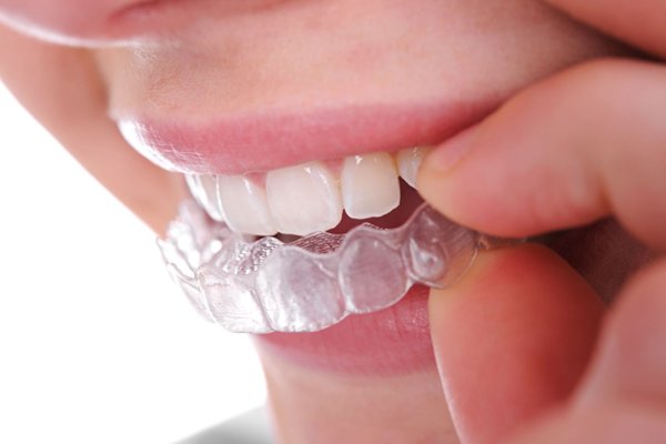 براکت ارتدنسی نامرئی چه ویژگی‌هایی دارد؟