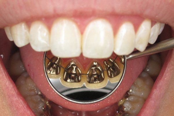 براکت ارتدنسی نامرئی چه ویژگی‌هایی دارد؟