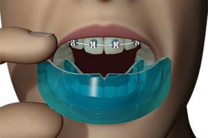 آیا ورزشکاران می‌توانند تحت درمان ارتدنسی قرار گیرند؟