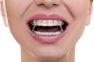 مشکلات نامرتبی دندانها