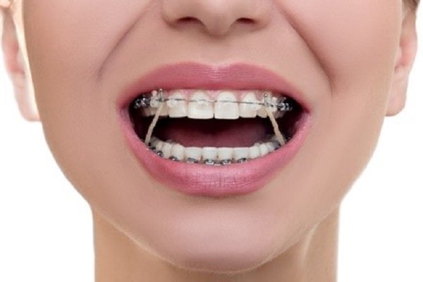 مشکلات نامرتبی دندانها